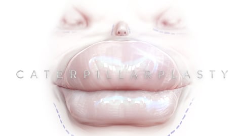 Caterpllarplasty cover image