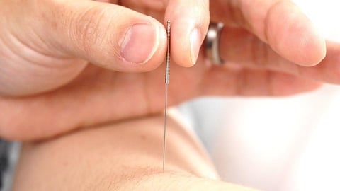 Effective Acupuncture cover image